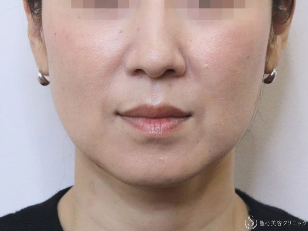 プレミアムPRP皮膚再生療法＋アンカーMAX_After