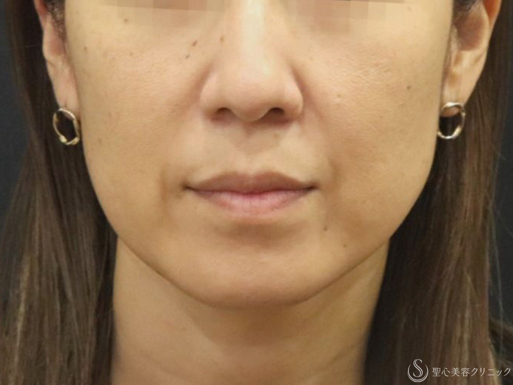 プレミアムPRP皮膚再生療法＋アンカーMAX_Before