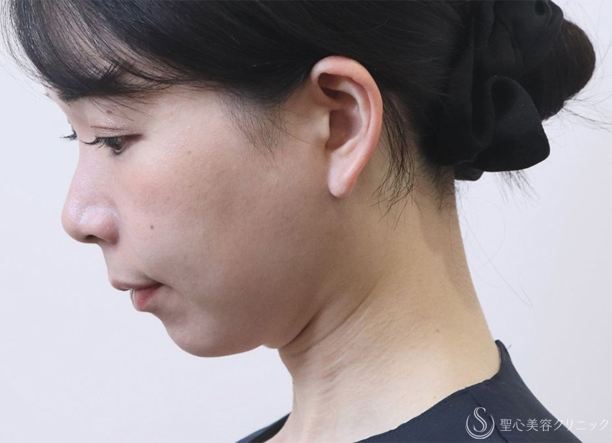 アンカーDXダブル_After