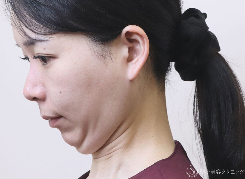 アンカーDXダブル_Before