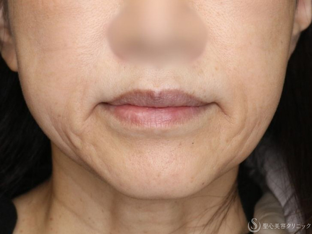 テスリフト（TESSリフト）_After