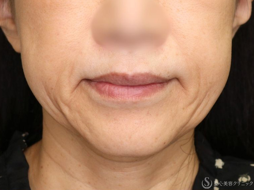 テスリフト（TESSリフト）_Before