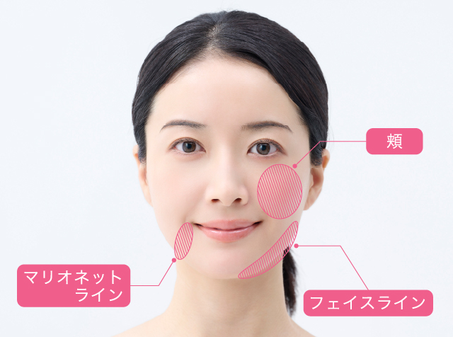 糸リフト（スレッドリフト）の適応部位