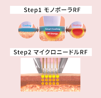 肌全体を整えてから、気になる部分を仕上げる治療