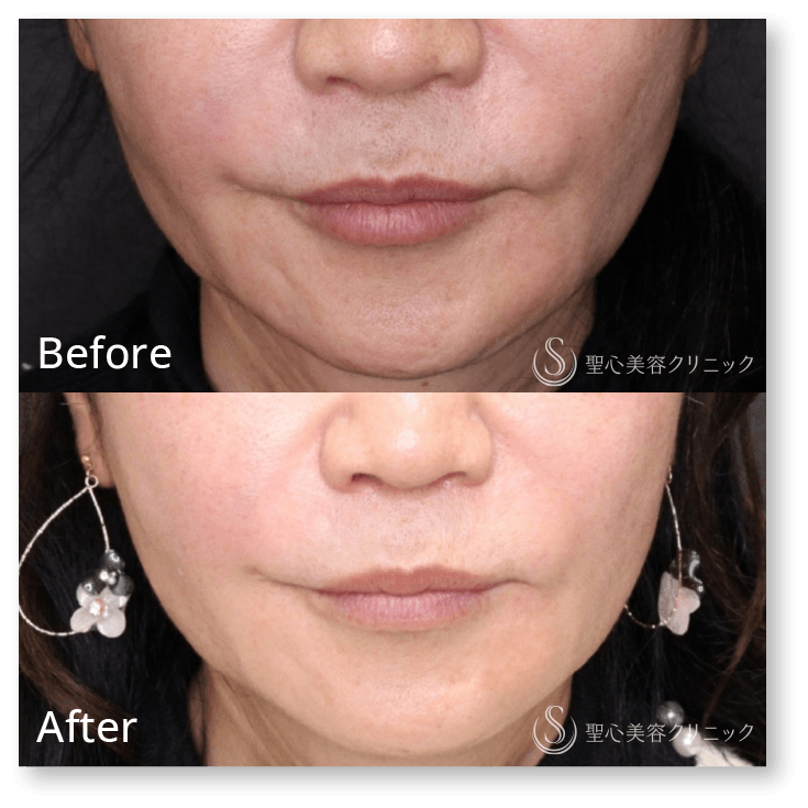 寺町 英明 聖心美容クリニック 大阪院院長/【糸リフト】PDRNモノスレッド(50本)