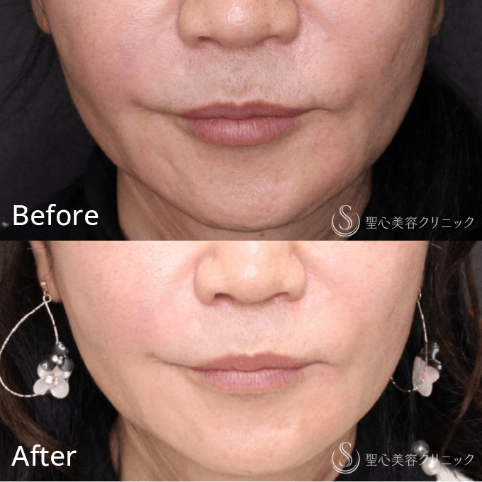 寺町 英明 聖心美容クリニック 大阪院院長/【糸リフト】PDRNモノスレッド(50本)