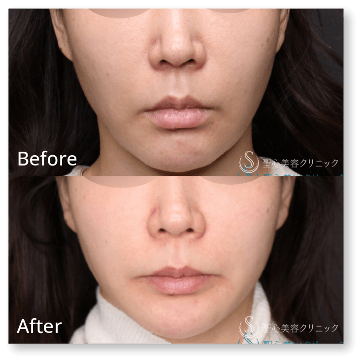寺町 英明 聖心美容クリニック 大阪院院長/【糸リフト】PDRNコーティングスレッド(10本)+PDRNモノスレッド(40本)