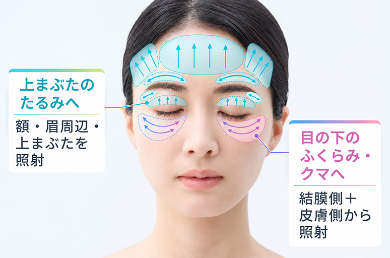 レーザーアイリフト